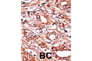 Formalin-fixed and paraffin-embedded human cancer tissue reacted with ABL1 (phospho Y134) polyclonal antibody  which was peroxidase-conjugated to the secondary antibody followed by AEC staining. (ABL1 Antikörper  (pTyr134))