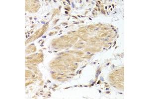 Immunohistochemistry of paraffin-embedded Human gastric cancer using CASP2 antibody at dilution of 1:100 (x400 lens). (Caspase 2 Antikörper)