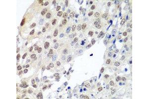 Immunohistochemistry of paraffin-embedded Human lung cancer using PTTG1 Polyclonal Antibody at dilution of 1:100 (40x lens). (PTTG1 Antikörper)
