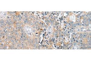 Immunohistochemistry of paraffin-embedded Human prost at e cancer tissue using COMMD6 Polyclonal Antibody at dilution of 1:45(x200) (COMMD6 Antikörper)