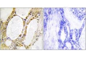 Immunohistochemistry analysis of paraffin-embedded human colon carcinoma tissue, using IRF2 Antibody.
