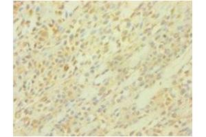 Immunohistochemistry of paraffin-embedded human breast cancer using ABIN7164283 at dilution of 1:100 (PICK1 Antikörper  (AA 1-200))