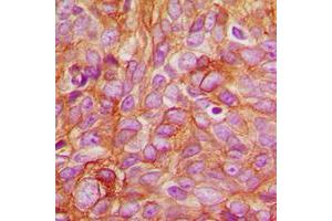 Immunohistochemical analysis of PKC delta (pT507) staining in human breast cancer formalin fixed paraffin embedded tissue section. (PKC delta Antikörper  (pSer507))