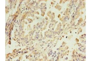 Immunohistochemistry of paraffin-embedded human lung cancer using ABIN7144550 at dilution of 1:100 (GIT2 Antikörper  (AA 1-603))