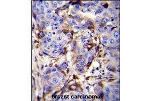 GCDFP-15 Antibody (C-term) (ABIN655074 and ABIN2844706) immunohistochemistry analysis in formalin fixed and paraffin embedded human breast carcinoma followed by peroxidase conjugation of the secondary antibody and DAB staining. (PIP Antikörper  (C-Term))