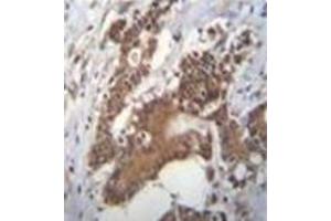 Immunohistochemistry analysis in formalin fixed and paraffin embedded human colon carcinoma reacted with PCYT1A Antibody (N-term) followed by peroxidase conjugation of the secondary antibody and DAB staining. (PCYT1A Antikörper  (N-Term))