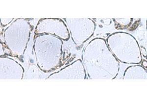 Immunohistochemistry of paraffin-embedded Human thyroid cancer tissue using POMC Polyclonal Antibody at dilution of 1:35(x200) (POMC Antikörper)