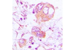 Immunohistochemical analysis of Cathepsin H staining in human lung cancer formalin fixed paraffin embedded tissue section. (Cathepsin H Antikörper  (Center))