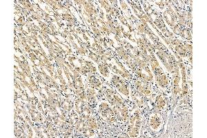 ABIN6263325 and ABIN6279013 at 1/100 staining human colorectal cancer and adjacent non-tumor tissue by IHC-P. (MOGAT3 Antikörper  (C-Term))