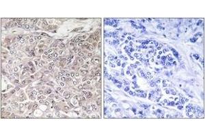 Immunohistochemistry analysis of paraffin-embedded human breast carcinoma, using GPRIN3 Antibody. (GPRIN3 Antikörper  (AA 131-180))