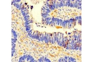 Immunohistochemistry of paraffin-embedded human ovarian cancer using ABIN7148136 at dilution of 1:100 (CCDC66 Antikörper  (AA 87-286))