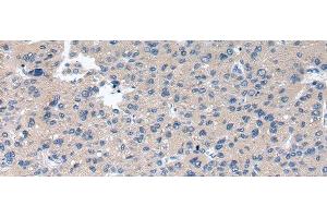 Immunohistochemistry of paraffin-embedded Human liver cancer using RAB2A Polyclonal Antibody at dilution of 1/40 (RAB2A Antikörper)