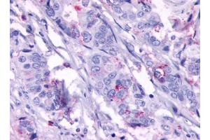 Immunohistochemical staining of Colon carcinoma (Neoplastic cells) using anti- GPR124 antibody ABIN122437 (GPR124 Antikörper)