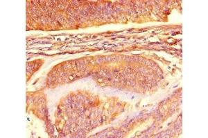 Immunohistochemistry of paraffin-embedded human endometrial cancer using ABIN7160847 at dilution of 1:100 (NAD-ME Antikörper  (AA 296-424))