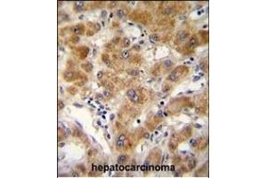ODF3B antibody (N-term) (ABIN654768 and ABIN2844448) immunohistochemistry analysis in formalin fixed and paraffin embedded human hepatocarcinoma followed by peroxidase conjugation of the secondary antibody and DAB staining.
