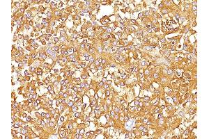 Formalin-fixed, paraffin-embedded human Melanoma stained with gp100 / Melanosome Monoclonal Antibody (SPM142). (Melanoma gp100 Antikörper)
