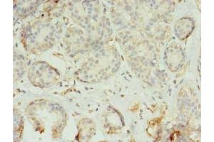 Immunohistochemistry of paraffin-embedded human breast cancer using ABIN7173225 at dilution of 1:100 (TMEM45A Antikörper  (AA 171-217))