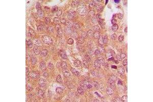 Immunohistochemical analysis of MID1 staining in human breast cancer formalin fixed paraffin embedded tissue section.