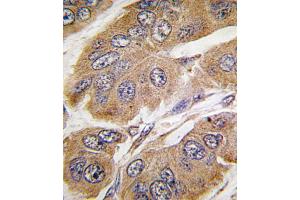 Formalin-fixed and paraffin-embedded human breast carcinoma tissue reacted with RPS6KB1 Antibody (T421) , which was peroxidase-conjugated to the secondary antibody, followed by DAB staining.