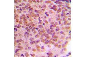 Immunohistochemical analysis of Cyclin B1 (pS126) staining in human breast cancer formalin fixed paraffin embedded tissue section.