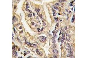 IHC analysis of FFPE human lung carcinoma tissue stained with CSF1R antibody (CSF1R Antikörper  (AA 940-971))