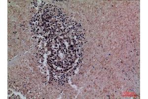 Immunohistochemistry (IHC) analysis of paraffin-embedded Human Lung Cancer, antibody was diluted at 1:100. (Surfactant Protein A1 Antikörper  (Internal Region))