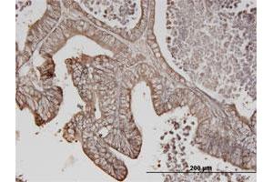 Immunoperoxidase of monoclonal antibody to ERBB3 on formalin-fixed paraffin-embedded human lung cancer. (ERBB3 Antikörper  (AA 21-331))