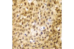Immunohistochemistry of paraffin-embedded human lung cancer using IRF3 antibody (ABIN5998002) at dilution of 1/100 (40x lens). (IRF3 Antikörper)