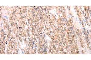 Immunohistochemistry of paraffin-embedded Human liver cancer tissue using ACIN1 Polyclonal Antibody at dilution 1:80 (ACIN1 Antikörper)