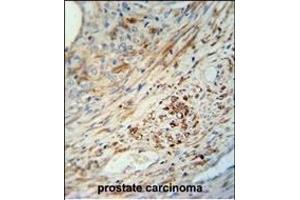 KIF9 antibody (C-term) (ABIN652134 and ABIN2840560) immunohistochemistry analysis in formalin fixed and paraffin embedded human prostate carcinoma followed by peroxidase conjugation of the secondary antibody and DAB staining. (KIF9 Antikörper  (C-Term))