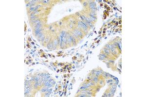 Immunohistochemistry of paraffin-embedded human colon carcinoma using MANF antibody. (MANF Antikörper)