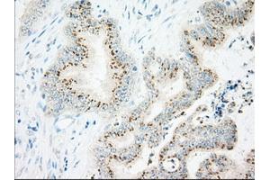Immunohistochemical staining of paraffin-embedded Adenocarcinoma of Human colon tissue using anti-IFT57 mouse monoclonal antibody. (IFT57 Antikörper)