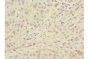 Immunohistochemistry of paraffin-embedded human liver cancer using ABIN7157914 at dilution of 1:100 (LSS Antikörper  (AA 1-300))