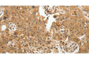Immunohistochemistry of paraffin-embedded Human lung cancer tissue using TFPI2 Polyclonal Antibody at dilution 1:30 (TFPI2 Antikörper)