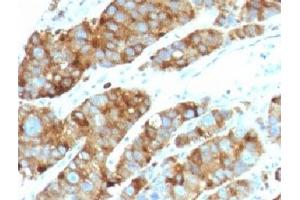 Formalin-fixed, paraffin-embedded human prostate carcinoma stained with LAMP3 antibody (LAMP3/968)