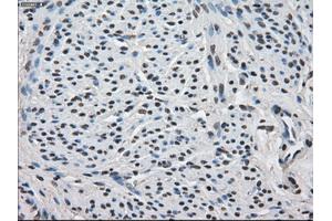 Immunohistochemical staining of paraffin-embedded Carcinoma of thyroid tissue using anti-FKBP5mouse monoclonal antibody. (FKBP5 Antikörper)