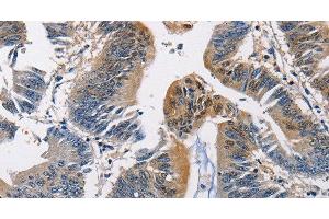 Immunohistochemistry of paraffin-embedded Human colon cancer using PGK1 Polyclonal Antibody at dilution of 1:50 (PGK1 Antikörper)