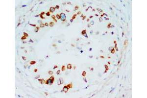 Immunohistochemical staining of LMNB1 on formalin fixed, paraffin embedded human mammary cancer with LMNB1 polyclonal antibody . (Lamin B1 Antikörper  (C-Term))