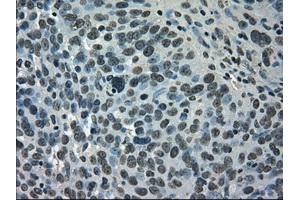 Immunohistochemical staining of paraffin-embedded Adenocarcinoma of breast tissue using anti-SATB1 mouse monoclonal antibody. (SATB1 Antikörper)