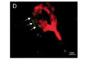 Immunofluorescence image of zonulin staining in cryosection of astrocytoma WHO III. (Zonulin Antikörper)