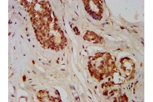 IHC image of ABIN7153745 diluted at 1:400 and staining in paraffin-embedded human breast cancer performed on a Leica BondTM system.