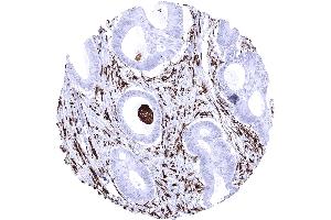 Colon HLA DR negative colorectal adenocarcinoma showing strong HLA DR positivity of capillaries and tumor associated inflammatory cells. (Rekombinanter HLA-DRA Antikörper)