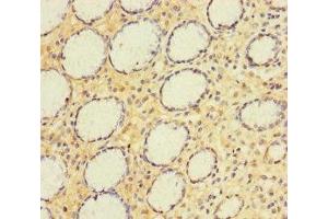 Immunohistochemistry of paraffin-embedded human gastric cancer using ABIN7143774 at dilution of 1:100 (A4GNT Antikörper  (AA 26-340))