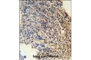 ZN antibody (N-term) (ABIN654489 and ABIN2844223) immunohistochemistry analysis in formalin fixed and paraffin embedded human lung carcinoma followed by peroxidase conjugation of the secondary antibody and DAB staining.