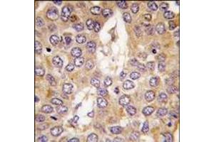 Formalin-fixed and paraffin-embedded human hepatocarcinoma tissue reacted with CK1g2 antibody (C-term), which was peroxidase-conjugated to the secondary antibody, followed by DAB staining. (Casein Kinase 1 gamma 2 Antikörper  (C-Term))