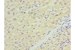 Immunohistochemistry of paraffin-embedded human liver cancer using ABIN7170048 at dilution of 1:100 (NKAIN4 Antikörper  (AA 83-150))