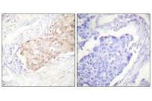 Immunohistochemistry analysis of paraffin-embedded human breast carcinoma tissue using EDD antibody. (UBR5 Antikörper)