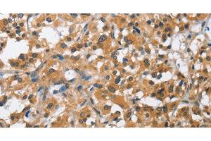 Immunohistochemistry of paraffin-embedded Human thyroid cancer using BCL10 Polyclonal Antibody at dilution of 1:40 (BCL10 Antikörper)