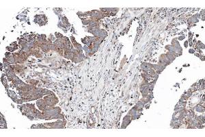 IHC-P Image Immunohistochemical analysis of paraffin-embedded human ovarian cancer, using NT5C2, antibody at 1:100 dilution.