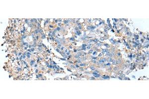 Immunohistochemistry of paraffin-embedded Human colorectal cancer tissue using DCX Polyclonal Antibody at dilution of 1:35(x200) (Doublecortin Antikörper)
